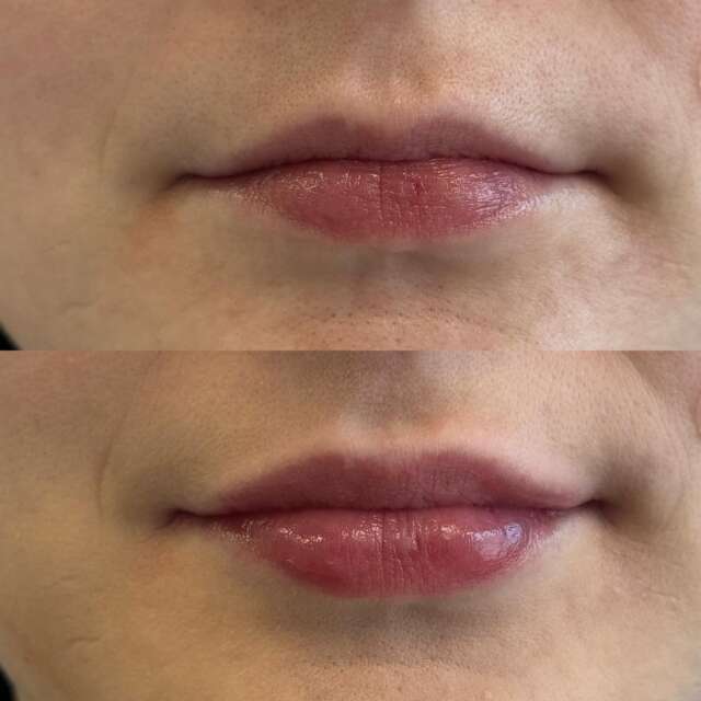 Powiększone usta 👄 mogą kojarzyć się z nienaturalnym, przesadzonym, nieestetycznym efektem. Tak naprawdę zabieg powiększania ust wykonany przez specjalistę👩‍⚕️ nadaje ustom naturalnego🌱, pełnego kształtu i efekt nawilżenia🧴.