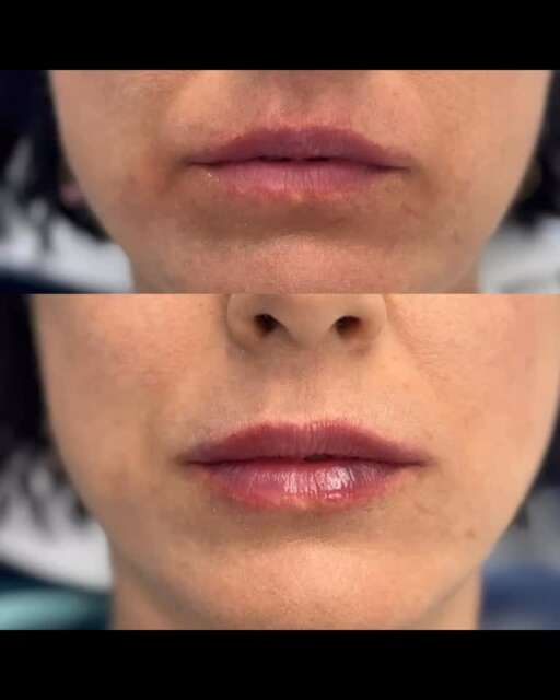 Lips balancing. Subtelne modelowanie ust. Lekkie wypełnienie, poprawa kształtu, przywrócenie sprężystości 💋