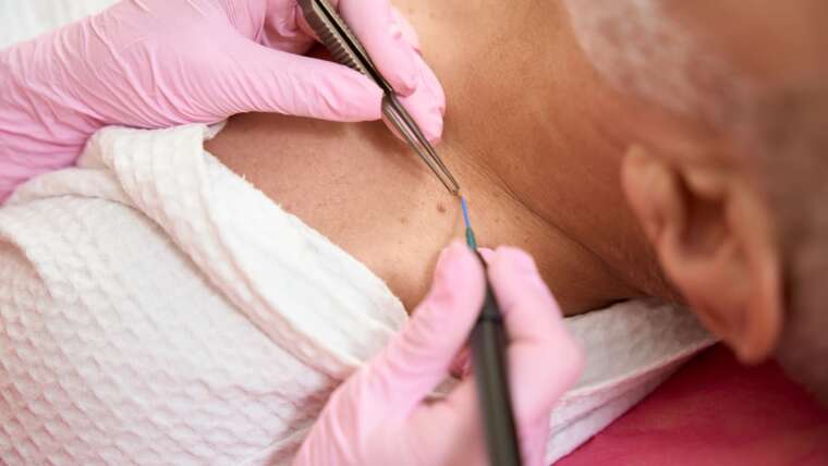 Kiedy warto zgłosić się do dermatologa ze znamieniem?